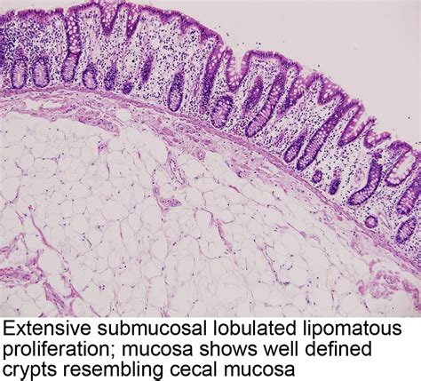 Pathology Outlines Lipomatosis Of The Ileocecal Valve