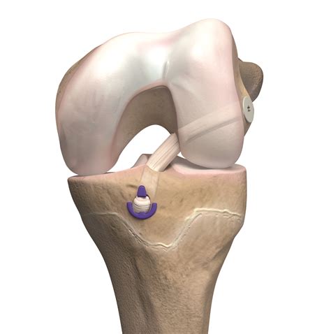 ACL Reconstruction System - ProxyMedical