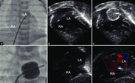 Balloon Septostomy Catheter Advanced A Through Restrictive Foramen