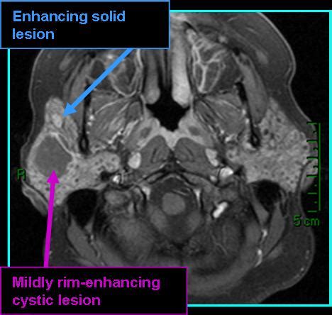 Benign Lymphoepithelial Lesions Radiology Iowa Head And Neck Protocols