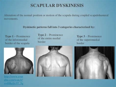 Scapular Dyskinesis Test Tips Flashcards | Quizlet