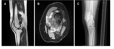 Figure From Limb Salvage Surgery In A Rare Case Of Recurrent