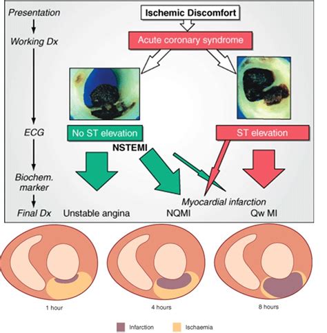 Uap Unstable Angina Pectoris Dan Nstemi Non St Elevated Myocardial