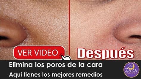 Como Eliminar Poros En La Cara Aquí Tienes El Mejor Ingrediente Natural Youtube