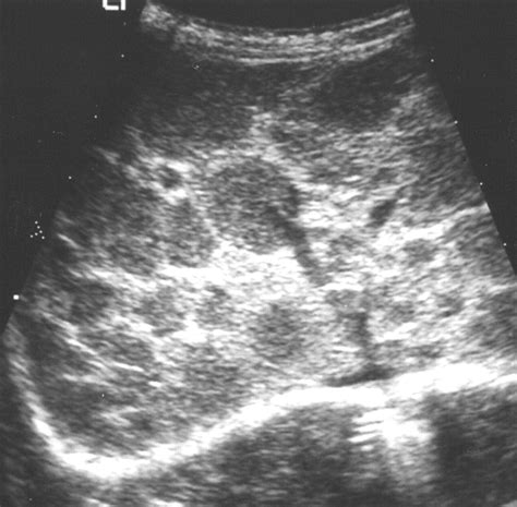 Infantile Hemangioma Ultrasound