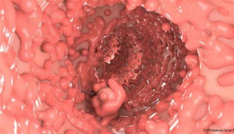 Non Cancerous Polyps In Colon