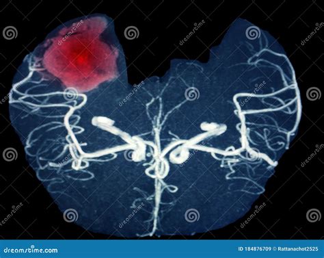 Mra Brain Or Magnetic Resonance Angiography Image Mra Of Cerebral