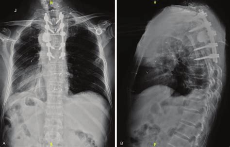 A Pa X Ray Image Of The Thoracic Spine Obtained Postoperatively B Download Scientific