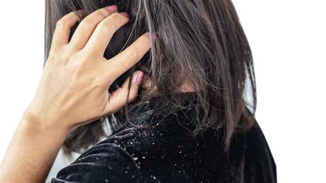 Dandruff Facts Myth And Major Understanding You Should Know