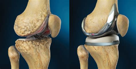 Total Knee Replacement