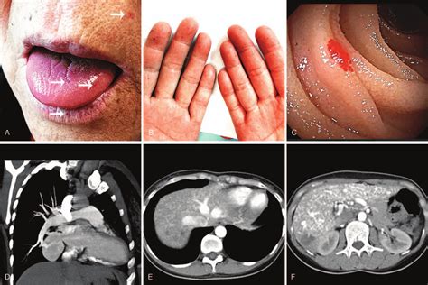 Hereditary Hemorrhagic Telangiectasia Brain