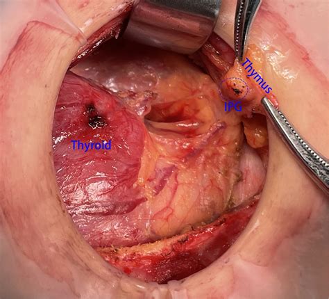 Frontiers An Improved Method Of Searching Inferior Parathyroid Gland