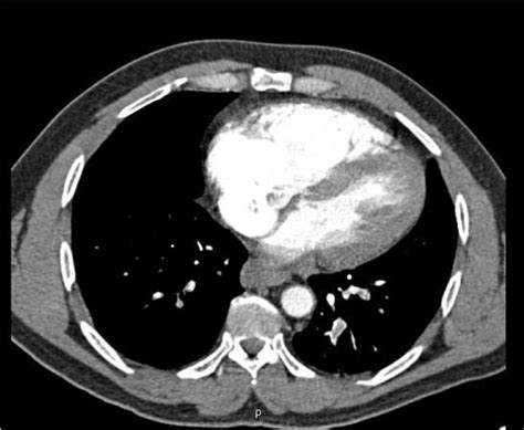 Interatrial Septum And Interventricular Septum