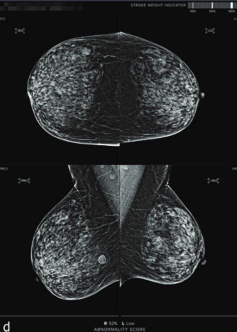 Seins denses l échographie meilleur complément à la mammographie