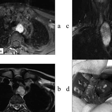 Mediastinal Parathyroid Adenoma Of 16 G Visualized On Transverse A B Download Scientific