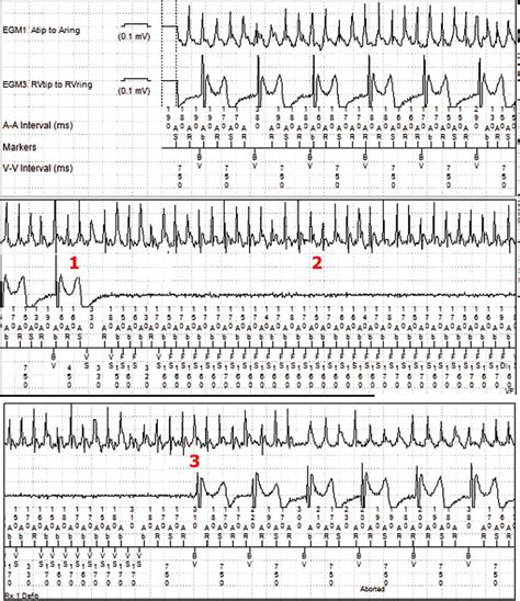 After Atrial Fibrillation With Biventricular Pacing Upper Panel