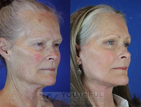 laser skin resurfacing    patient  nashville