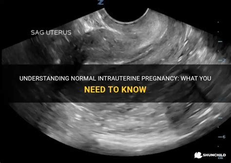 Understanding Normal Intrauterine Pregnancy: What You Need To Know ...