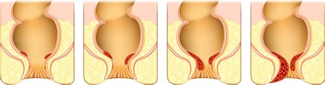 Zivilisationskrankheit H Morrhoiden Landkreis Passau Kliniken