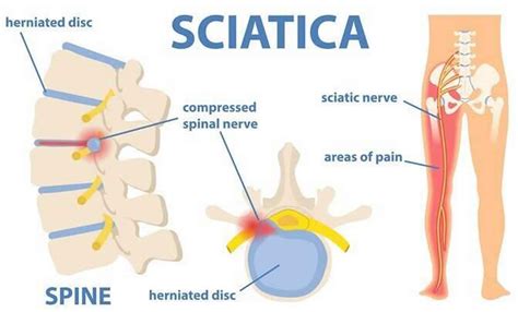 Sciatica Sciatica Pain Causes Diagnosis Treatment Exercises Prognosis