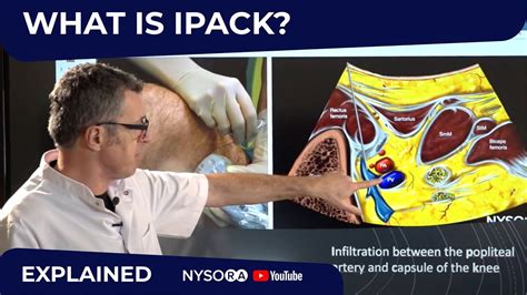 What Is Ipack Regional Anesthesia Crash Course With Dr Hadzic YouTube