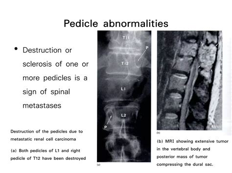 Applied Cross Sectional Anatomy Of Spinal Cord Ppt