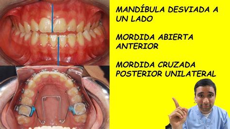 Ortodoncia En Una Paciente Que Tenía Desviación De La Mandíbula 😎 Es Lo