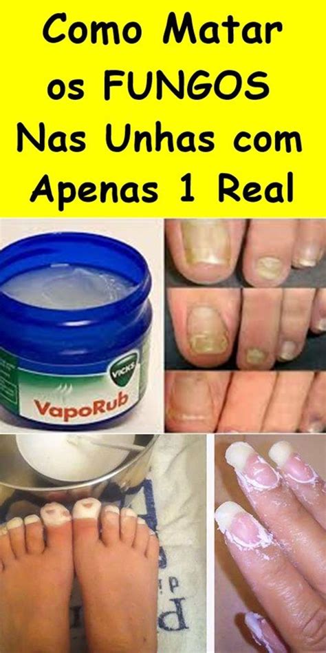 Como Matar Os Fungos Nas Unhas Apenas 1 Real Fungos Nas Unhas