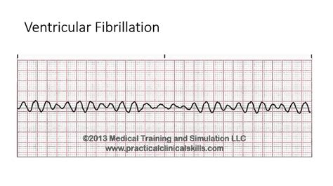 Fine Ventricular Fibrillation