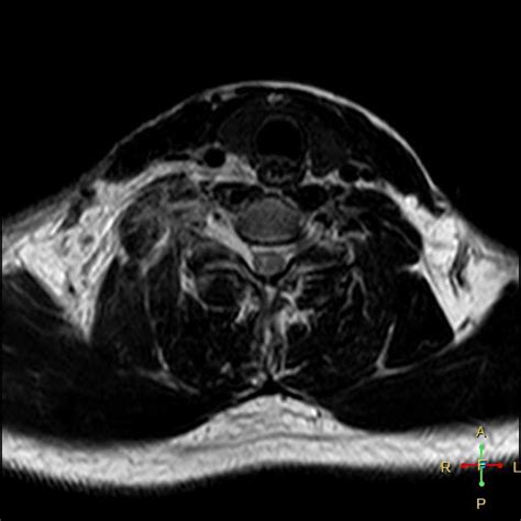 Brachial Plexus Injury Image Radiopaedia Org