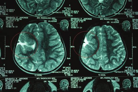 Schizencephaly: Axial T2-weighted MRI showed gray matter lined cleft... | Download Scientific ...