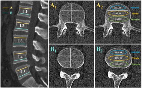 Frontiers Hounsfield Unit For Assessing Bone Mineral Density Distribution Within Lumbar