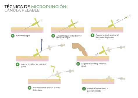 Canalizaci N Picc Neonatal Con T Cnica Microseldinger C Nula Pelable