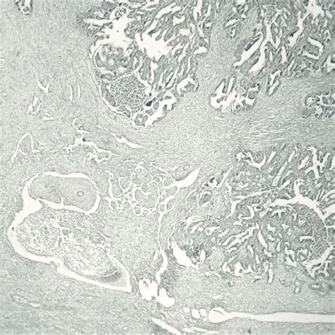Ovarian Hemangioma Composed Of Numerous Small Vascular Spaces The