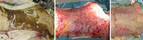 Full Thickness Burn Injury Before And After Excision And After