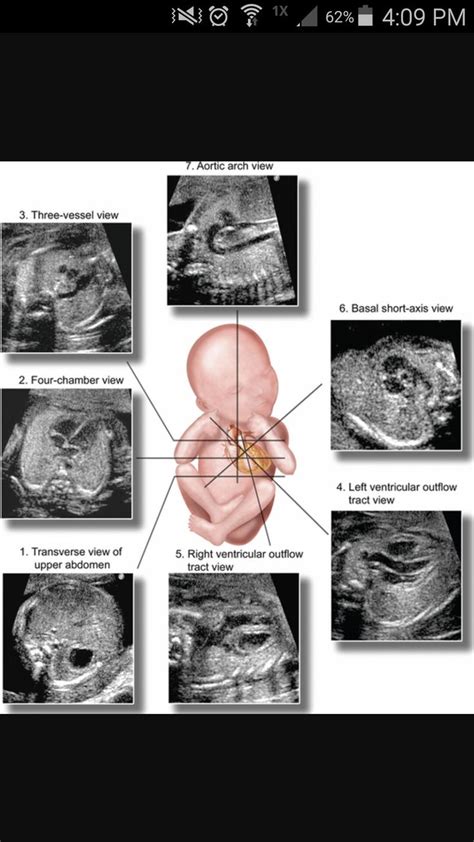 Pin By Phuong Hoai On Fetal Ultrasound Medical Ultrasound Ultrasound