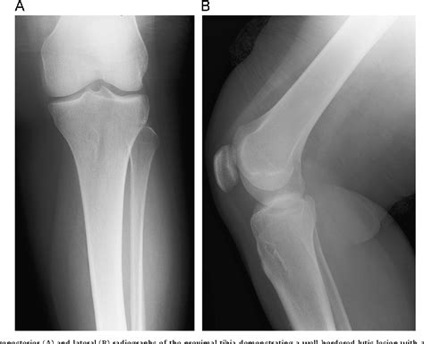 Figure 1 From Solitary Intraosseous Myofibroma Of The Tibia In An Adult Patient A Case Report