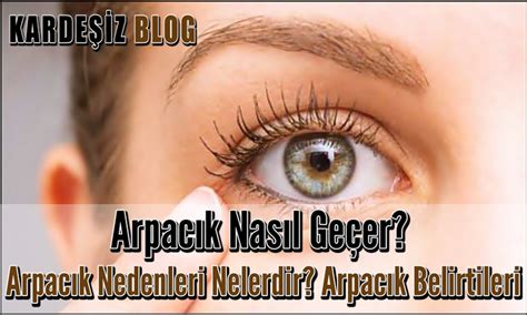 Arpacık Nasıl Geçer Arpacık Nedenleri Nelerdir Arpacık Belirtileri