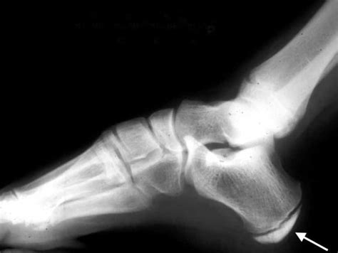 Heel Pain In Kids Profeet Podiatry