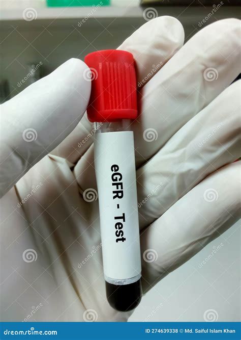 Blood Sample For EGFR Estimated Glomerular Filtration Rate Test