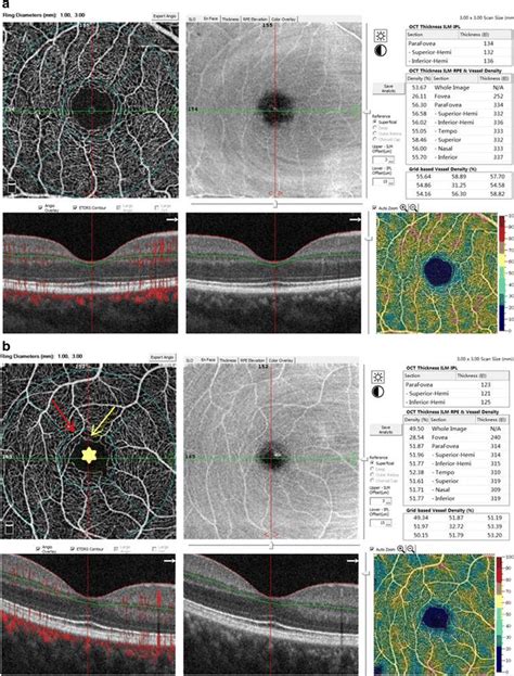 Assessment Of Capillary Dropout In The Superficial Retinal Capillary