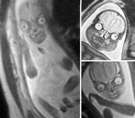 Mri Scan Reveals Pregnant Womans Baby Is The True King Of The Walls