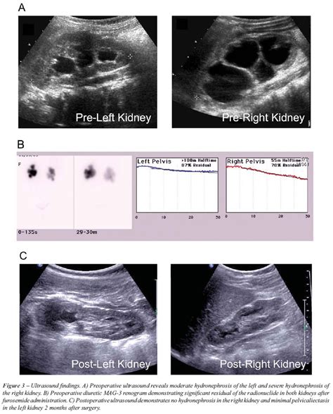 Scielo Brasil Concurrent Management Of Bilateral Ureteropelvic