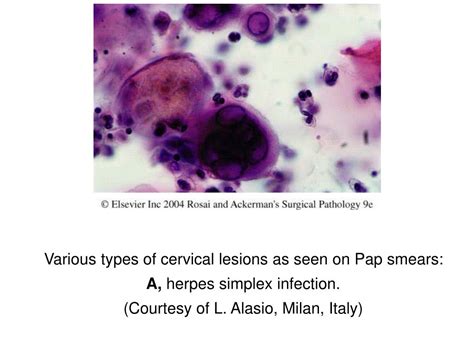 Ppt Various Types Of Cervical Lesions As Seen On Pap Smears A