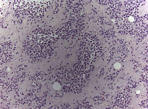 Year Old Female With Metastatic Rhabdomyosarcoma The Core Biopsy