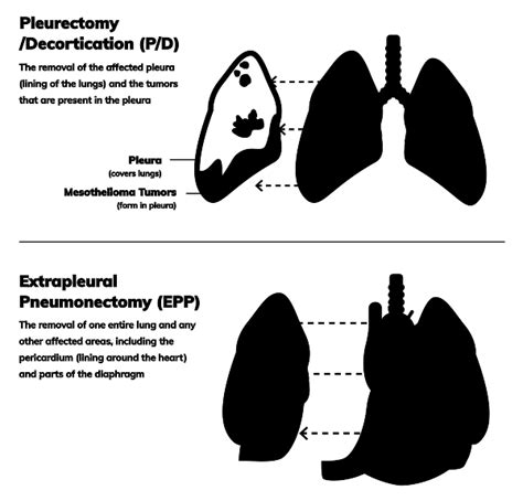 Epithelioid Mesothelioma Treatment Prognosis And Diagnosis