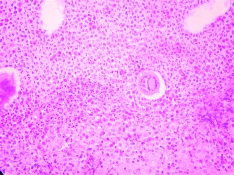 The Granuloma Is Composed Of Epitheloid Histiocytes And A Lot Of Download Scientific Diagram