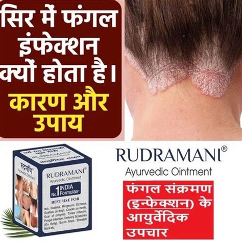 Ayurvedic Anti Fungal Rudramani Ointment Cream Bottle At Rs 100 In Surat