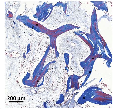 New Bone Formation Months After V Cba Implantation Masson S