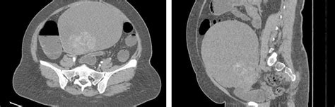 Sertoliform Endometrioid Carcinoma Of The Right Ovary In Endocrinology